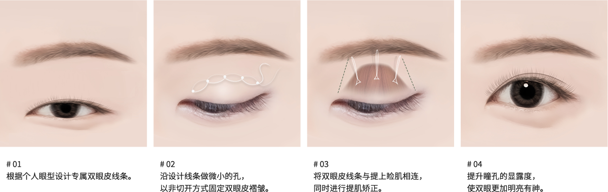 # 비절개 눈매교정 수술방법