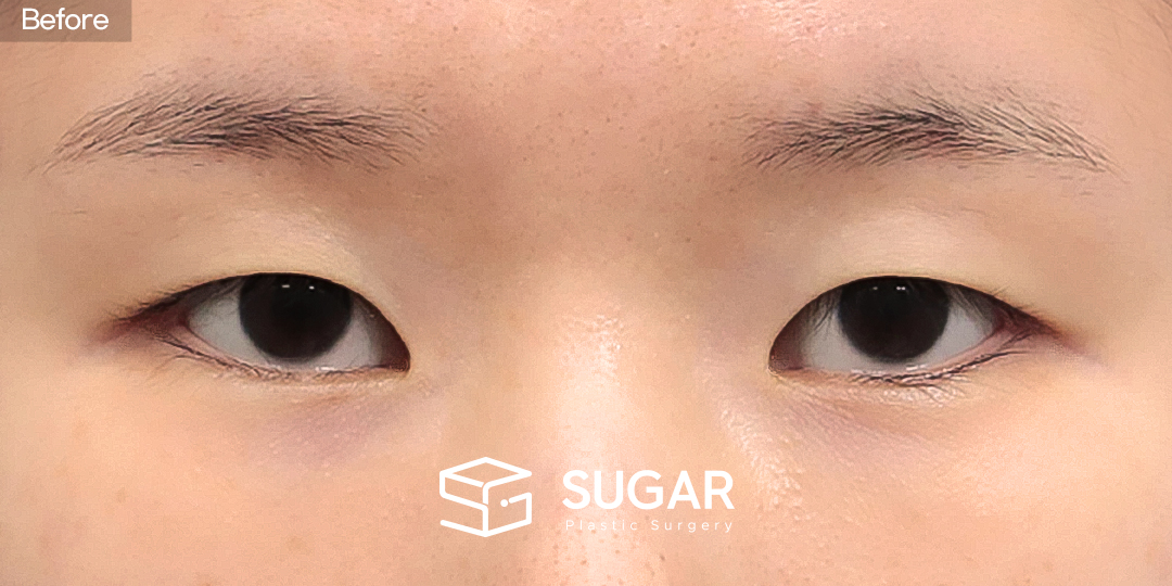 SUGAR整形外科 初次) 埋线法 + 提肌矫正 + 内眼角 术前术后照片 - 术前