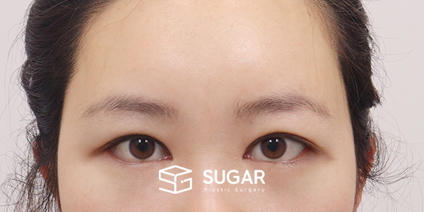 SUGAR整形外科 额部提升 + 自然粘连 + 外眼角 + 下至 术前术后照片 - 术后