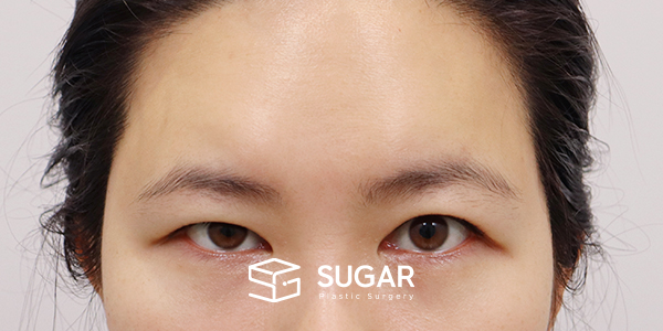 SUGAR整形外科 额部提升 + 自然粘连 + 外眼角 + 下至 术前术后照片 - 术前