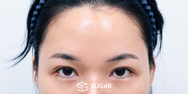 SUGAR整形外科 外眼角下至 / 初次) 额部提升 术前术后照片 - 术前
