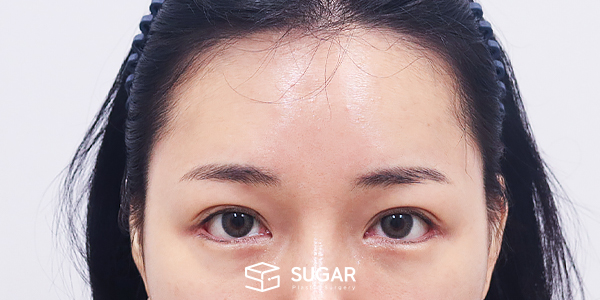 SUGAR整形外科 外眼角下至 / 初次) 额部提升 术前术后照片 - 术后