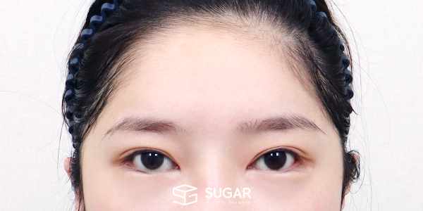 SUGAR整形外科 外眼角下至 / 初次) 额部提升 术前术后照片 - 术前