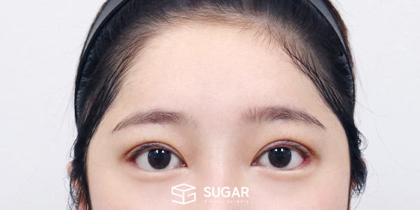 SUGAR整形外科 外眼角下至 / 初次) 额部提升 术前术后照片 - 术后