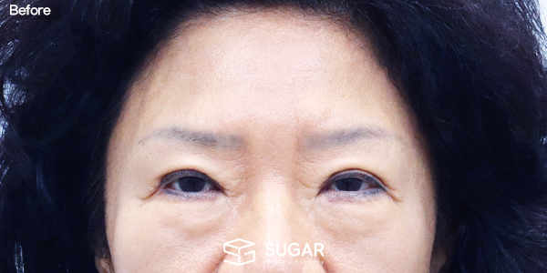 SUGAR整形外科 下睑成形术 + 中面部提升 + 额部提升 术前术后照片 - 术前