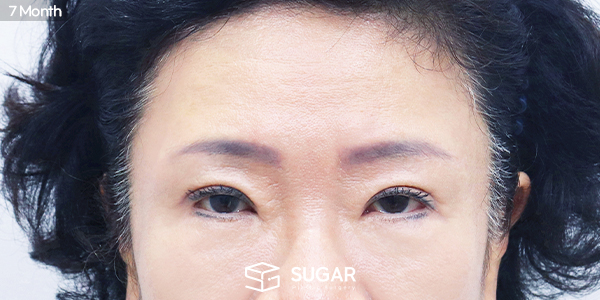 SUGAR整形外科 下睑成形术 + 中面部提升 + 额部提升 术前术后照片 - 术后