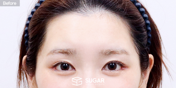SUGAR整形外科 额部提升 术前术后照片 - 术前