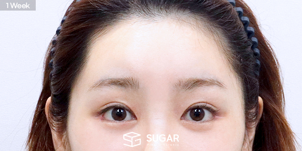 SUGAR整形外科 额部提升 术前术后照片 - 术后