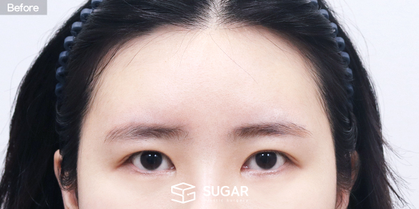 SUGAR整形外科 自然粘连 + 上眼角 + 外眼角下至 + 额部提升 术前术后照片 - 术前