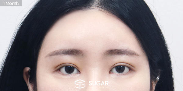 SUGAR整形外科 自然粘连 + 上眼角 + 外眼角下至 + 额部提升 术前术后照片 - 术后