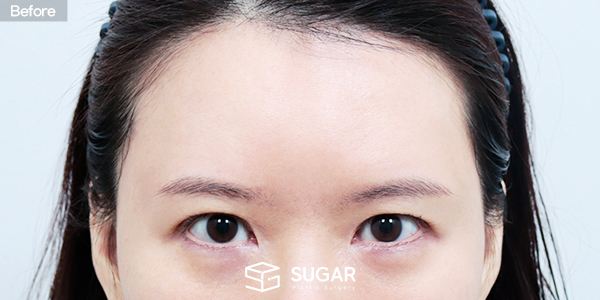 SUGAR整形外科 自然粘连 + 额部提升 术前术后照片 - 术前