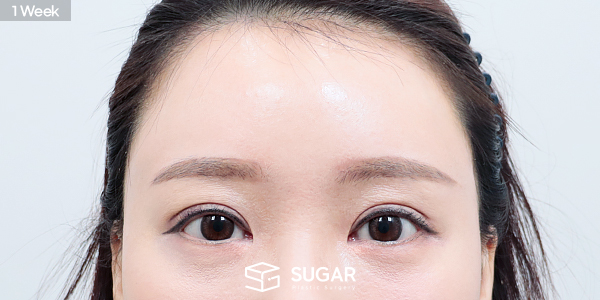 SUGAR整形外科 自然粘连 + 额部提升 术前术后照片 - 术后
