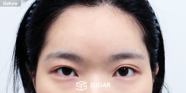 SUGAR整形外科 切开双眼皮 / 初次) 提肌矫正 / 修复) 外眼角下至 / 初次) 额部提升 术前术后照片 - 术前