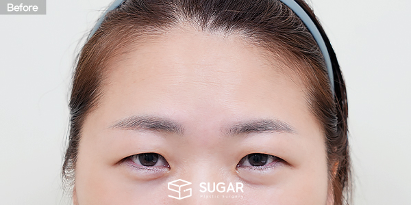 SUGAR整形外科 额部提升 + 自然粘连 + 上眼睑脂肪去除 + 上眼角 + 外眼角下至 术前术后照片 - 术前