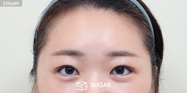 SUGAR整形外科 额部提升 + 自然粘连 + 上眼睑脂肪去除 + 上眼角 + 外眼角下至 术前术后照片 - 术后
