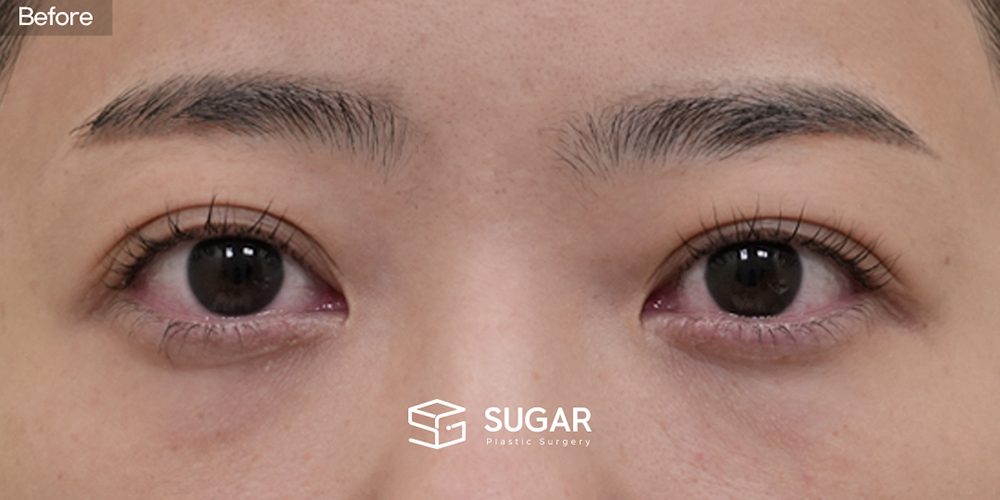 SUGAR整形外科 初次) 眼下脂肪重排 + 额部提升 + 无假体 + 自体肋软骨 + 鼻翼缩小 + 福鼻 + 鼻柱延长 术前术后照片 - 术前