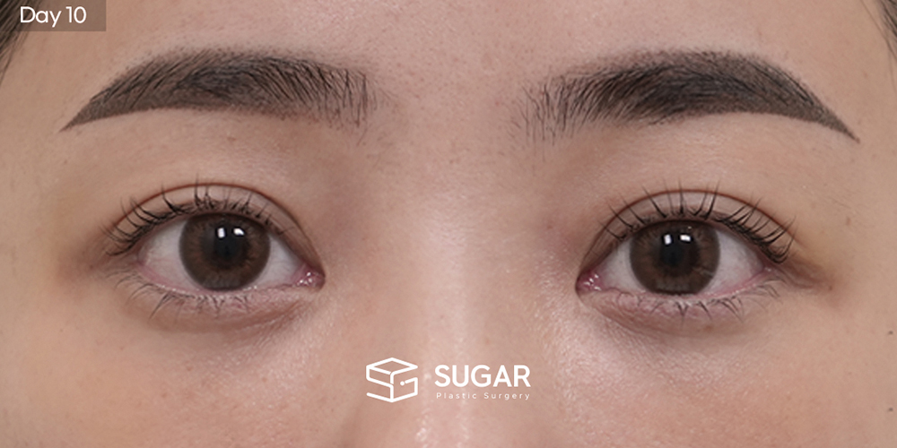 SUGAR整形外科 初次) 眼下脂肪重排 + 额部提升 + 无假体 + 自体肋软骨 + 鼻翼缩小 + 福鼻 + 鼻柱延长 术前术后照片 - 术后