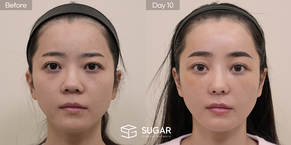 SUGAR整形外科 初次) 眼下脂肪重排 + 额部提升 + 无假体 + 自体肋软骨 + 鼻翼缩小 + 福鼻 + 鼻柱延长 术前术后照片 - 正面术前术后对比