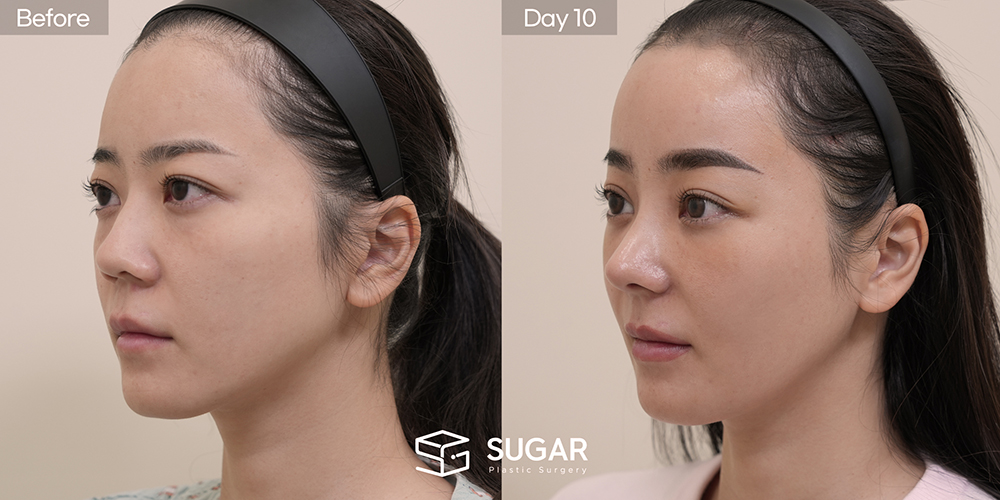 SUGAR整形外科 初次) 眼下脂肪重排 + 额部提升 + 无假体 + 自体肋软骨 + 鼻翼缩小 + 福鼻 + 鼻柱延长 术前术后照片 - 45度术前术后对比