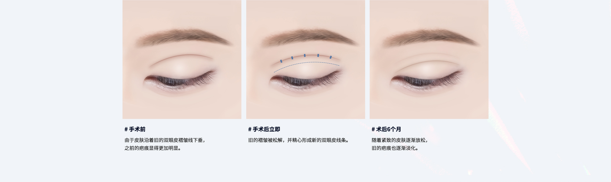 # 手术前 : 由于皮肤沿着旧的双眼皮褶皱线下垂，之前的疤痕显得更加明显。 / # 手术后立即 : 旧的褶皱被松解，并精心形成新的双眼皮线条。/ # 术后6个月 : 随着紧致的皮肤逐渐放松，旧的疤痕也逐渐淡化。