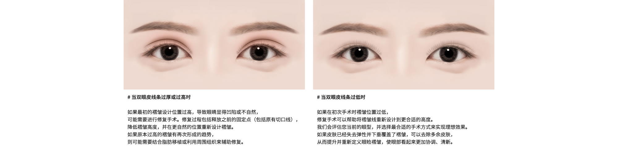 # 当双眼皮线条过厚或过高时 : 如果最初的褶皱设计位置过高，导致眼睛显得凹陷或不自然，可能需要进行修复手术。修复过程包括释放之前的固定点（包括原有切口线），降低褶皱高度，并在更自然的位置重新设计褶皱。如果原本过高的褶皱有再次形成的趋势，则可能需要结合脂肪移植或利用周围组织来辅助修复。/ # 当双眼皮线条过低时 : 如果在初次手术时褶皱位置过低，修复手术可以帮助将褶皱线重新设计到更合适的高度。我们会评估您当前的眼型，并选择最合适的手术方式来实现理想效果。如果皮肤已经失去弹性并下垂覆盖了褶皱，可以去除多余皮肤，从而提升并重新定义眼睑褶皱，使眼部看起来更加协调、清新。