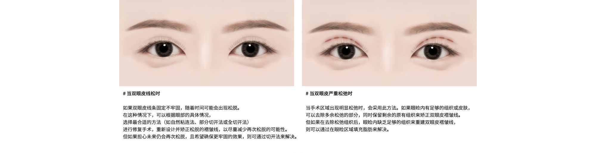 # 当双眼皮线松时 : 如果双眼皮线条固定不牢固，随着时间可能会出现松脱。在这种情况下，可以根据眼部的具体情况，选择最合适的方法（如自然粘连法、部分切开法或全切开法）进行修复手术，重新设计并矫正松脱的褶皱线，以尽量减少再次松脱的可能性。但如果担心未来仍会再次松脱，且希望确保更牢固的效果，则可通过切开法来解决。/ # 当双眼皮严重松弛时 : 当手术区域出现明显松弛时，会采用此方法。如果眼睑内有足够的组织或皮肤，可以去除多余松弛的部分，同时保留剩余的原有组织来矫正双眼皮褶皱线。但如果在去除松弛组织后，眼睑内缺乏足够的组织来重建双眼皮褶皱线，则可以通过在眼睑区域填充脂肪来解决。