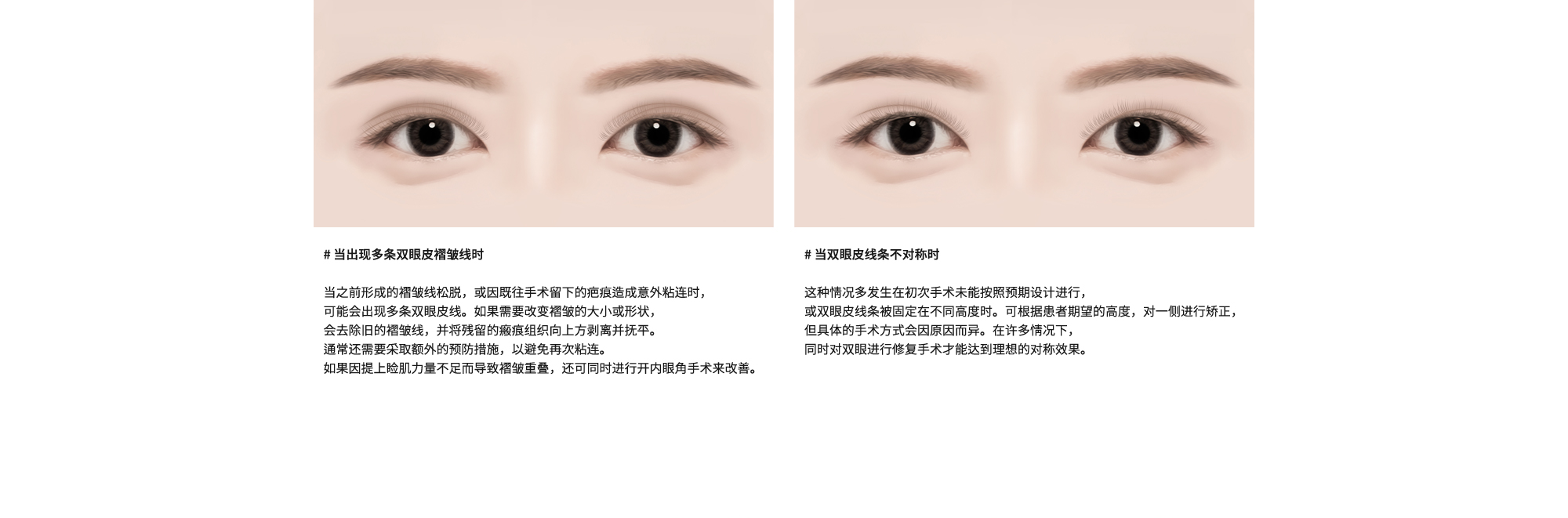 # 当出现多条双眼皮褶皱线时 : 当之前形成的褶皱线松脱，或因既往手术留下的疤痕造成意外粘连时，可能会出现多条双眼皮线。如果需要改变褶皱的大小或形状，会去除旧的褶皱线，并将残留的瘢痕组织向上方剥离并抚平。通常还需要采取额外的预防措施，以避免再次粘连。如果因提上睑肌力量不足而导致褶皱重叠，还可同时进行开内眼角手术来改善。/ # 当双眼皮线条不对称时 : 这种情况多发生在初次手术未能按照预期设计进行，或双眼皮线条被固定在不同高度时。可根据患者期望的高度，对一侧进行矫正，但具体的手术方式会因原因而异。在许多情况下，同时对双眼进行修复手术才能达到理想的对称效果。