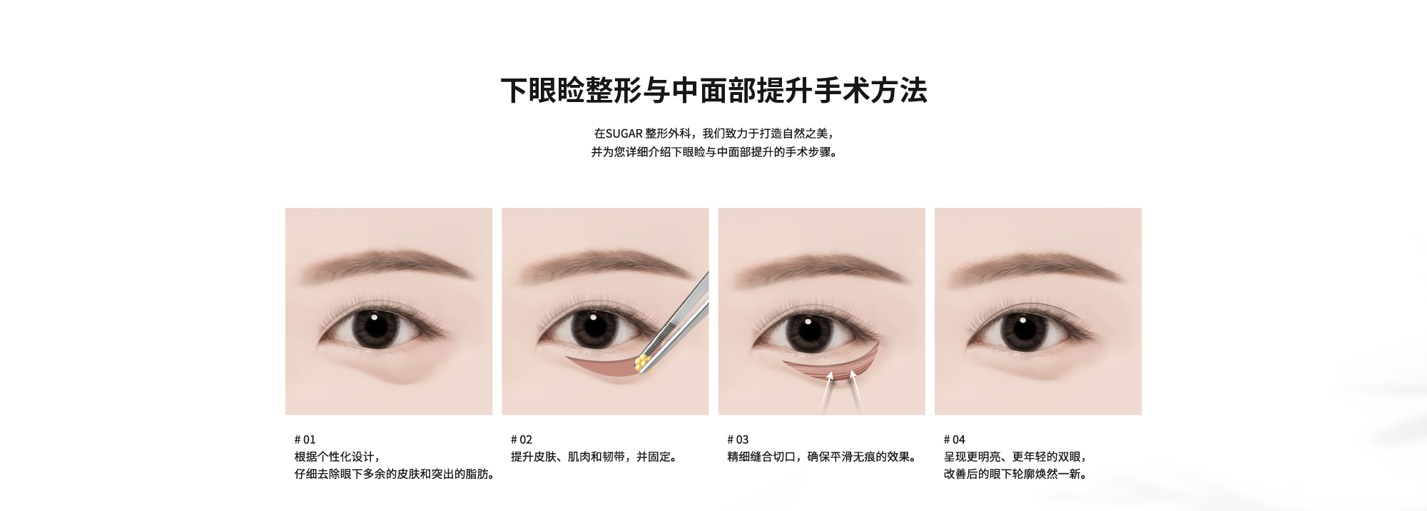 [下眼睑整形与中面部提升手术方法] 在SUGAR 整形外科，我们致力于打造自然之美，并为您详细介绍下眼睑与中面部提升的手术步骤。# 01 : 根据个性化设计，仔细去除眼下多余的皮肤和突出的脂肪。  # 02 : 提升皮肤、肌肉和韧带，并固定。  # 03 : 精细缝合切口，确保平滑无痕的效果。  # 04 : 呈现更明亮、更年轻的双眼，改善后的眼下轮廓焕然一新。