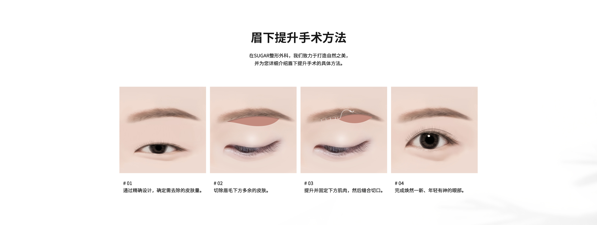 [眉下提升手术方法] 在SUGAR整形外科，我们致力于打造自然之美，并为您详细介绍眉下提升手术的具体方法。# 01 : 通过精确设计，确定需去除的皮肤量。  # 02 : 切除眉毛下方多余的皮肤。  # 03 : 提升并固定下方肌肉，然后缝合切口。  # 04 : 完成焕然一新、年轻有神的眼部。