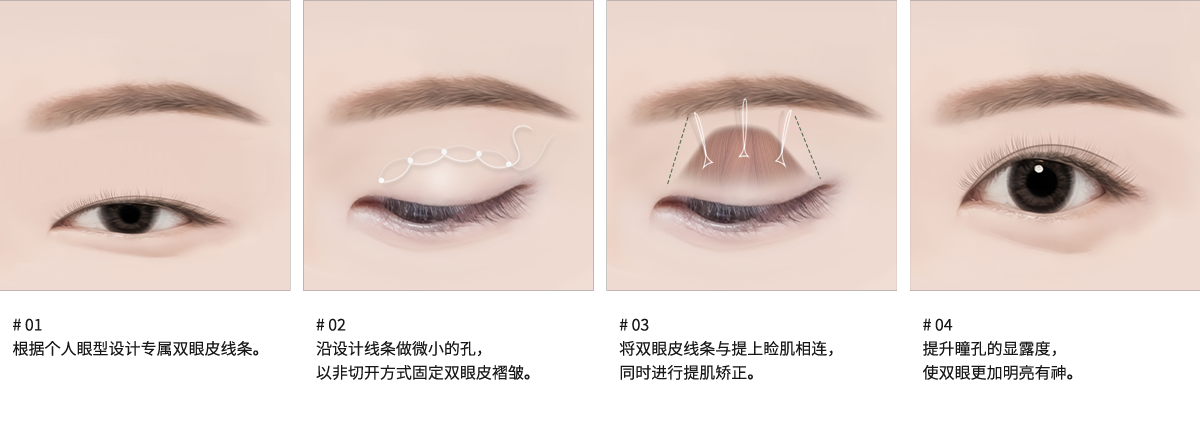 # 01 : 根据个人眼型设计专属双眼皮线条。  # 02 : 沿设计线条做微小的孔，以非切开方式固定双眼皮褶皱。  # 03 : 将双眼皮线条与提上睑肌相连，同时进行提肌矫正。  # 04 : 提升瞳孔的显露度，使双眼更加明亮有神。