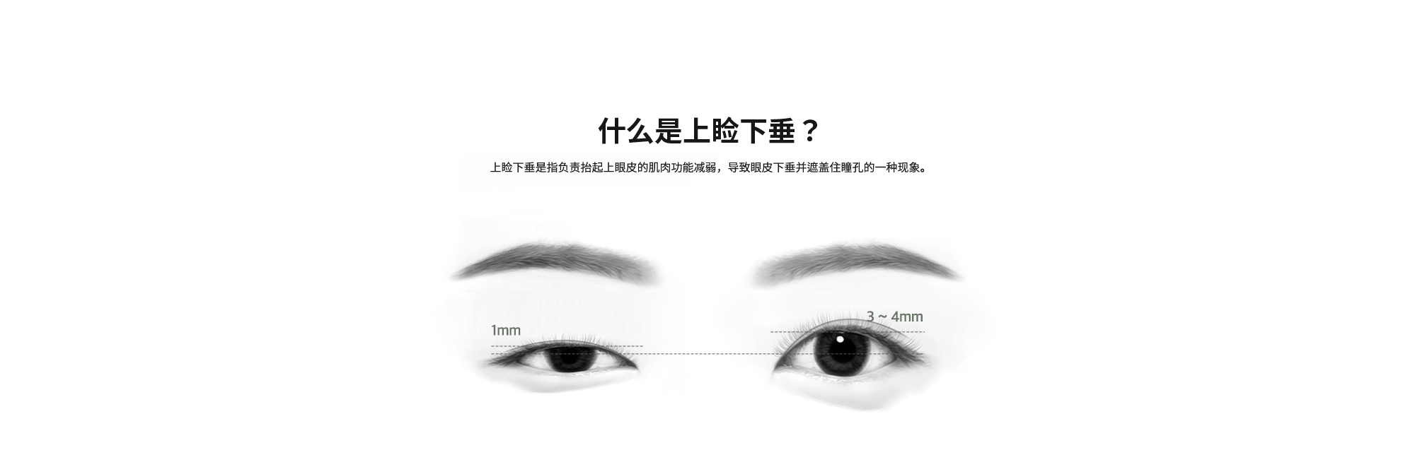 [什么是上睑下垂？] 上睑下垂是指负责抬起上眼皮的肌肉功能减弱，导致眼皮下垂并遮盖住瞳孔的一种现象。