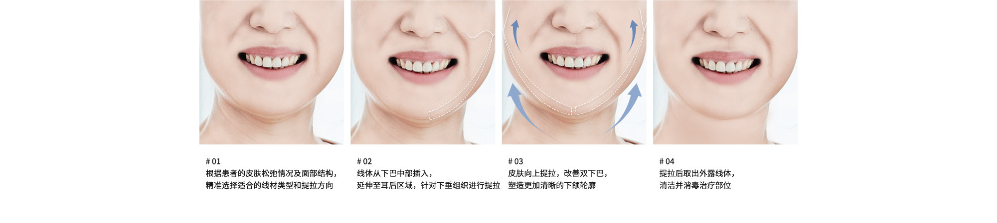 # 01 : 根据患者的皮肤松弛情况及面部结构，精准选择适合的线材类型和提拉方向 | # 02 : 线体从下巴中部插入，延伸至耳后区域，针对下垂组织进行提拉 | # 03 : 皮肤向上提拉，改善双下巴，塑造更加清晰的下颌轮廓 | # 04 : 提拉后取出外露线体，清洁并消毒治疗部位