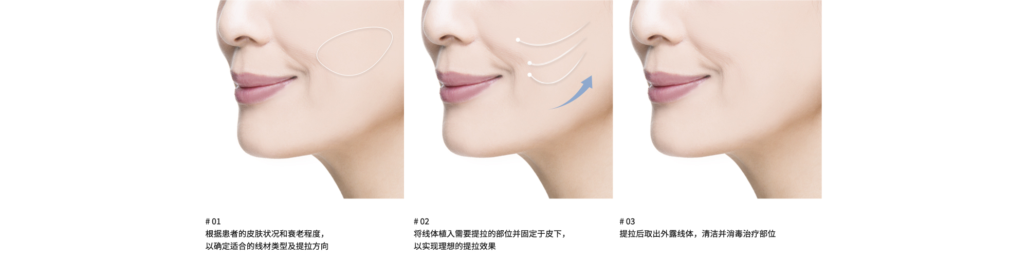 # 01 : 根据患者的皮肤状况和衰老程度，以确定适合的线材类型及提拉方向 | # 02 : 将线体植入需要提拉的部位并固定于皮下，以实现理想的提拉效果 | # 03 : 提拉后取出外露线体，清洁并消毒治疗部位
