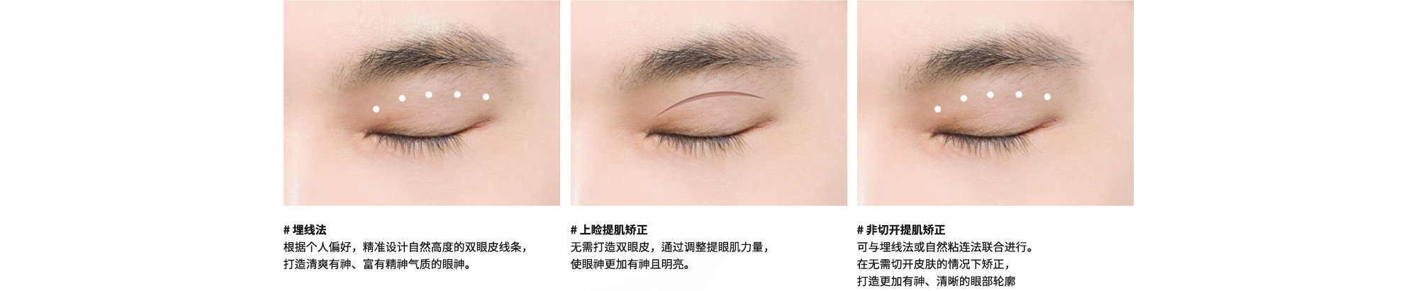 # 埋线法 : 根据个人偏好，精准设计自然高度的双眼皮线条，打造清爽有神、富有精神气质的眼神。 | # 上睑提肌矫正 : 无需打造双眼皮，通过调整提眼肌力量，使眼神更加有神且明亮。 | # 非切开提肌矫正 : 可与埋线法或自然粘连法联合进行。在无需切开皮肤的情况下矫正，打造更加有神、清晰的眼部轮廓
