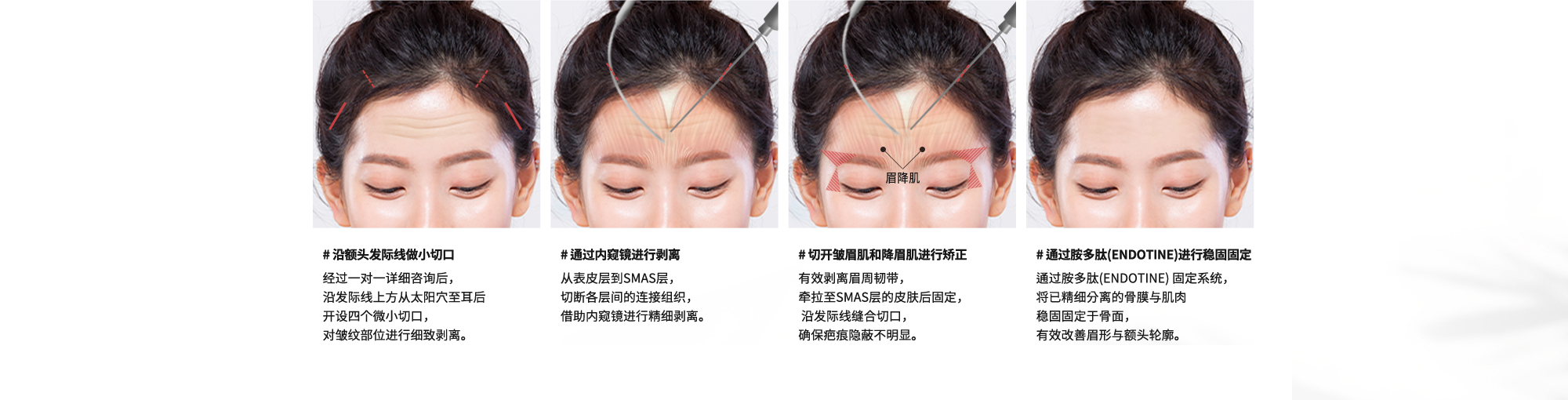{沿额头发际线做小切口} 经过一对一详细咨询后，沿发际线上方从太阳穴至耳后开设四个微小切口，对皱纹部位进行细致剥离。 {通过内窥镜进行剥离} 从表皮层到SMAS层，切断各层间的连接组织，借助内窥镜进行精细剥离。  {切开皱眉肌和降眉肌进行矫正} 有效剥离眉周韧带，牵拉至SMAS层的皮肤后固定， 沿发际线缝合切口，确保疤痕隐蔽不明显。  {通过胺多肽(ENDOTINE)进行稳固固定} 通过胺多肽(ENDOTINE) 固定系统，将已精细分离的骨膜与肌肉稳固固定于骨面，有效改善眉形与额头轮廓。