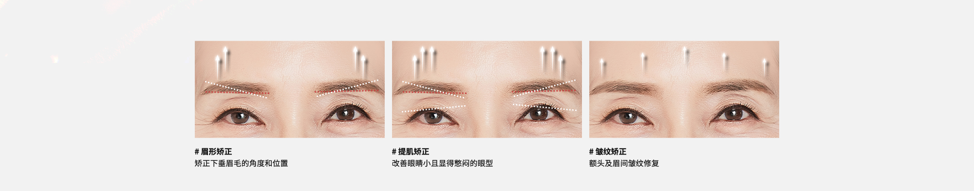 #眉形矫正 : 矫正下垂眉毛的角度和位置  #提肌矫正 : 改善眼睛小且显得憋闷的眼型  #皱纹矫正 : 额头及眉间皱纹修复