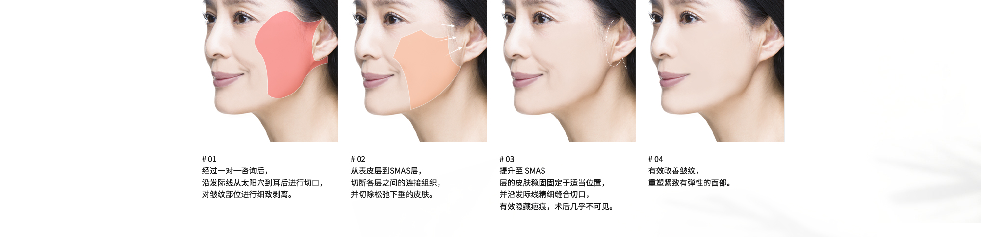 # 01 : 经过一对一咨询后，沿发际线从太阳穴到耳后进行切口，对皱纹部位进行细致剥离。  # 02 : 从表皮层到SMAS层，切断各层之间的连接组织，并切除松弛下垂的皮肤。  # 03 : 提升至 SMAS 层的皮肤稳固固定于适当位置，并沿发际线精细缝合切口，有效隐藏疤痕，术后几乎不可见。  # 04 : 有效改善皱纹，重塑紧致有弹性的面部。