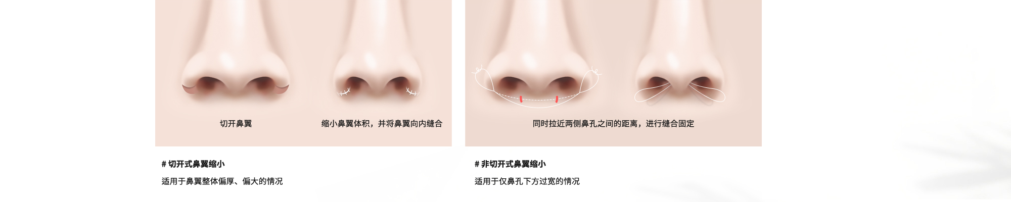# 切开式鼻翼缩小 : 适用于鼻翼整体偏厚、偏大的情况  # 非切开式鼻翼缩小 : 适用于仅鼻孔下方过宽的情况