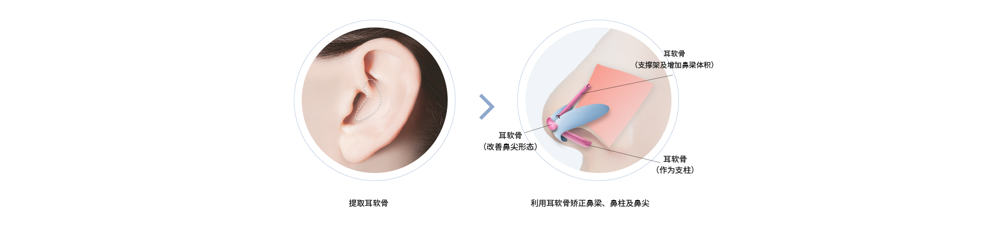 提取耳软骨 > 利用耳软骨矫正鼻梁、鼻柱及鼻尖