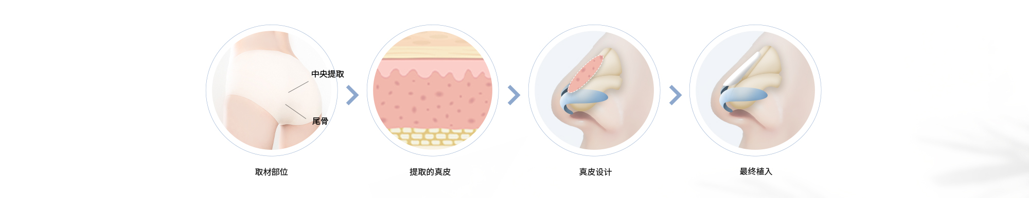 取材部位 >  提取的真皮 > 真皮设计 > 最终植入