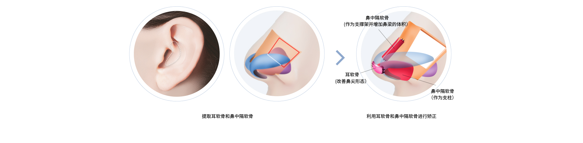 提取耳软骨和鼻中隔软骨 > 利用耳软骨和鼻中隔软骨进行矫正