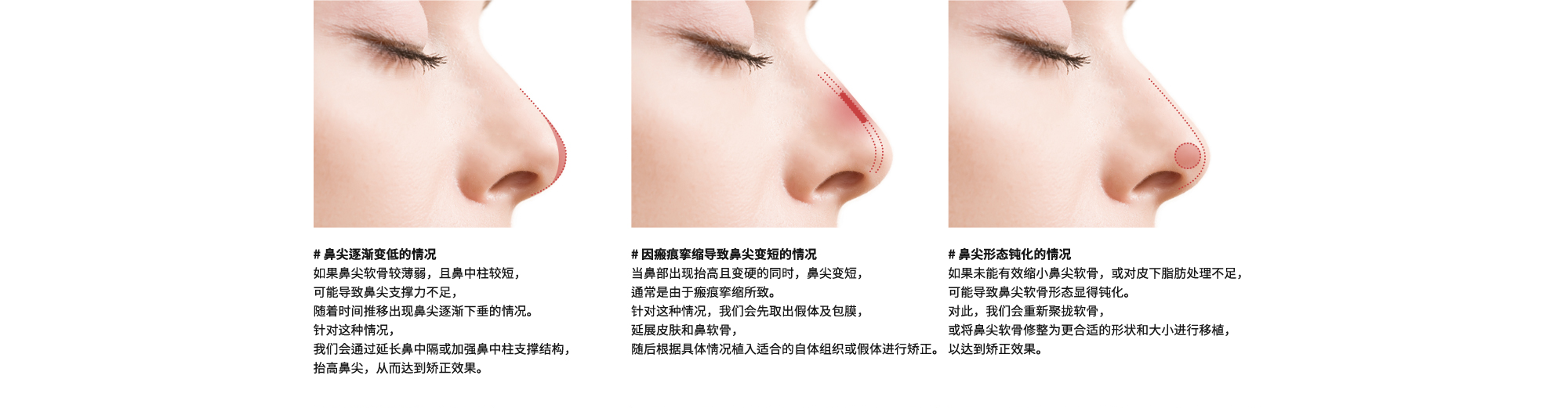 # 鼻尖逐渐变低的情况 : 如果鼻尖软骨较薄弱，且鼻中柱较短，可能导致鼻尖支撑力不足，随着时间推移出现鼻尖逐渐下垂的情况。针对这种情况，我们会通过延长鼻中隔或加强鼻中柱支撑结构，抬高鼻尖，从而达到矫正效果。| # 因瘢痕挛缩导致鼻尖变短的情况 : 当鼻部出现抬高且变硬的同时，鼻尖变短，通常是由于瘢痕挛缩所致。针对这种情况，我们会先取出假体及包膜，延展皮肤和鼻软骨，随后根据具体情况植入适合的自体组织或假体进行矫正。 | # 鼻尖形态钝化的情况 : 如果未能有效缩小鼻尖软骨，或对皮下脂肪处理不足，可能导致鼻尖软骨形态显得钝化。对此，我们会重新聚拢软骨，或将鼻尖软骨修整为更合适的形状和大小进行移植，以达到矫正效果。