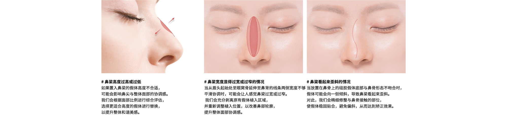 # 鼻梁高度过高或过低 : 如果置入鼻梁的假体高度不合适，可能会影响鼻尖与整体面部的协调感。我们会根据面部比例进行综合评估，选择更适合高度的假体进行替换，以提升整体和谐美感。| # 鼻梁宽度显得过宽或过窄的情况 : 当从眉头起始处至眼窝骨延伸至鼻背的线条两侧宽度不够平滑协调时，可能会让人感觉鼻梁过宽或过窄。 我们会充分剥离原有假体植入区域，并重新调整植入位置，以改善鼻部轮廓，提升整体面部协调感。| # 鼻梁看起来歪斜的情况 : 当放置在鼻骨上的硅胶假体底部与鼻骨形态不吻合时，假体可能会向一侧倾斜，导致鼻梁看起来歪斜。对此，我们会精细修整与鼻骨接触的部位，使假体稳固贴合，避免偏斜，从而达到矫正效果。