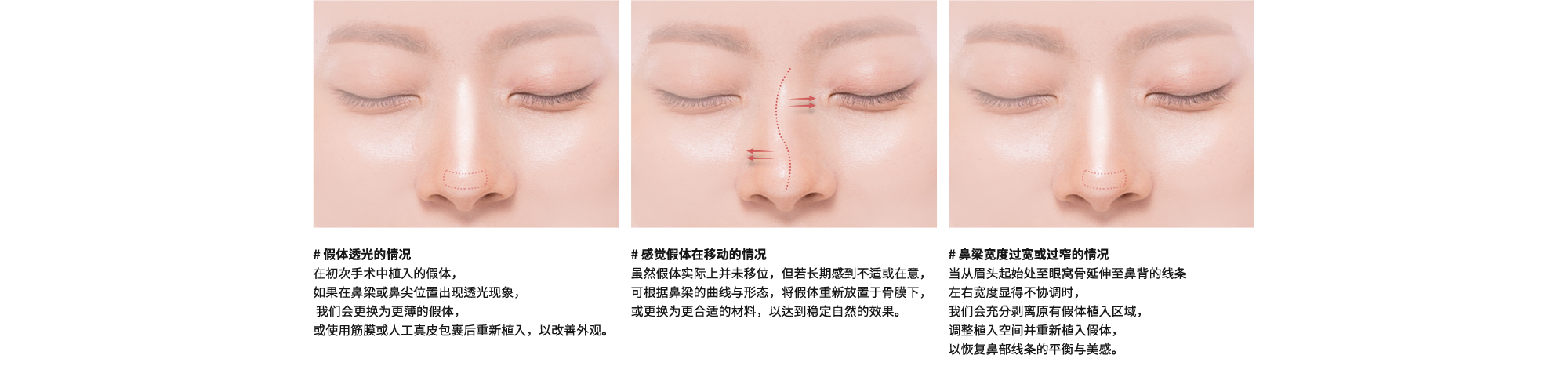 # 假体透光的情况 : 在初次手术中植入的假体，如果在鼻梁或鼻尖位置出现透光现象，我们会更换为更薄的假体，或使用筋膜或人工真皮包裹后重新植入，以改善外观。| # 感觉假体在移动的情况 : 虽然假体实际上并未移位，但若长期感到不适或在意，可根据鼻梁的曲线与形态，将假体重新放置于骨膜下，或更换为更合适的材料，以达到稳定自然的效果。| # 鼻梁宽度过宽或过窄的情况 : 当从眉头起始处至眼窝骨延伸至鼻背的线条左右宽度显得不协调时，我们会充分剥离原有假体植入区域，调整植入空间并重新植入假体，以恢复鼻部线条的平衡与美感。