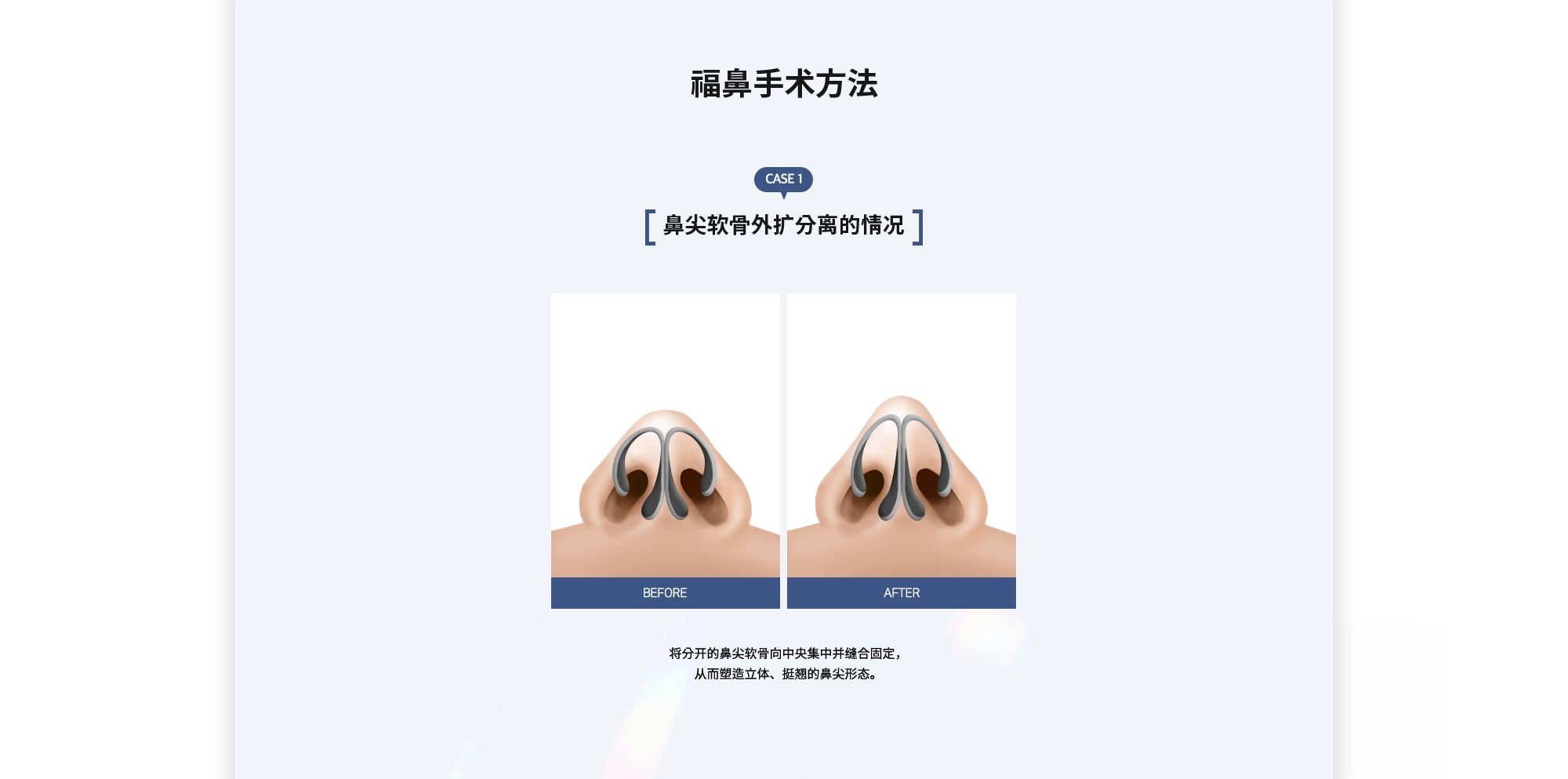 [福鼻手术方法] {CASE 1 : 鼻尖软骨外扩分离的情况} 将分开的鼻尖软骨向中央集中并缝合固定，从而塑造立体、挺翘的鼻尖形态。