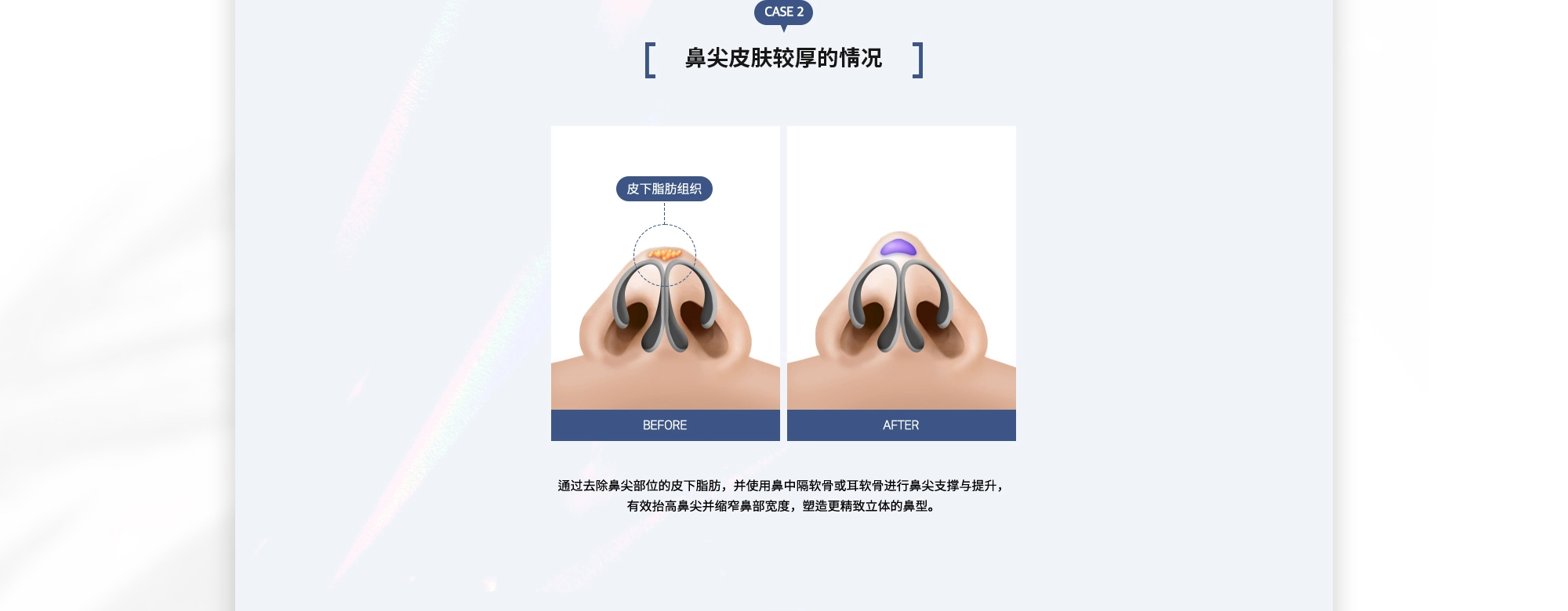 {CASE 2 : 鼻尖皮肤较厚的情况} 通过去除鼻尖部位的皮下脂肪，并使用鼻中隔软骨或耳软骨进行鼻尖支撑与提升，有效抬高鼻尖并缩窄鼻部宽度，塑造更精致立体的鼻型。