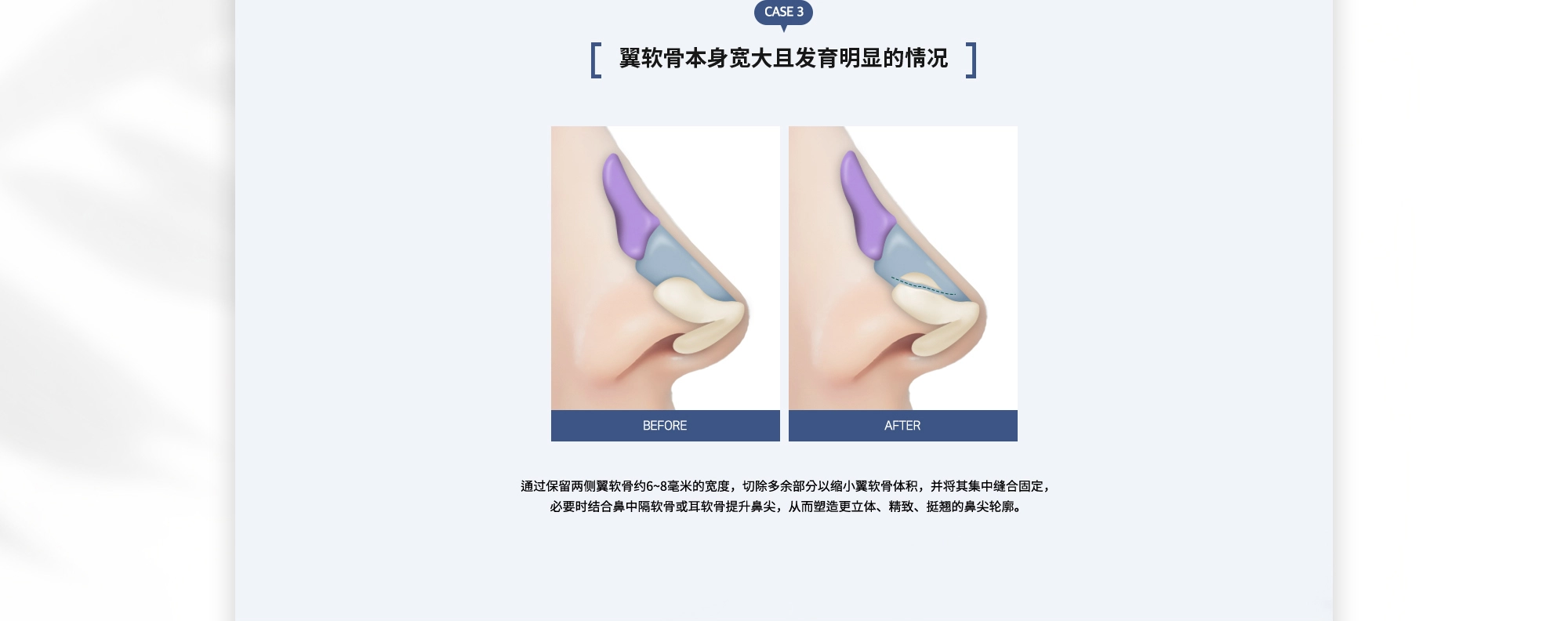 {CASE 3 : 翼软骨本身宽大且发育明显的情况} 通过保留两侧翼软骨约6~8毫米的宽度，切除多余部分以缩小翼软骨体积，并将其集中缝合固定，必要时结合鼻中隔软骨或耳软骨提升鼻尖，从而塑造更立体、精致、挺翘的鼻尖轮廓。