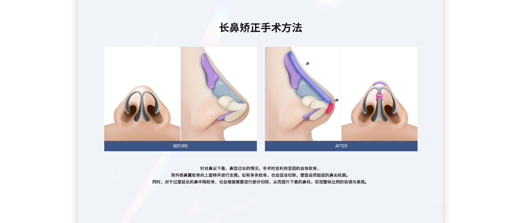 [长鼻矫正手术方法] 针对鼻尖下垂、鼻型过长的情况，手术时会利用坚固的自体软骨，将外侧鼻翼软骨向上旋转并进行支撑。如有多余软骨，也会适当切除，塑造自然挺拔的鼻尖轮廓。同时，对于过度延长的鼻中隔软骨，也会根据需要进行部分切除，从而提升下垂的鼻柱，实现整体比例的协调与美观。