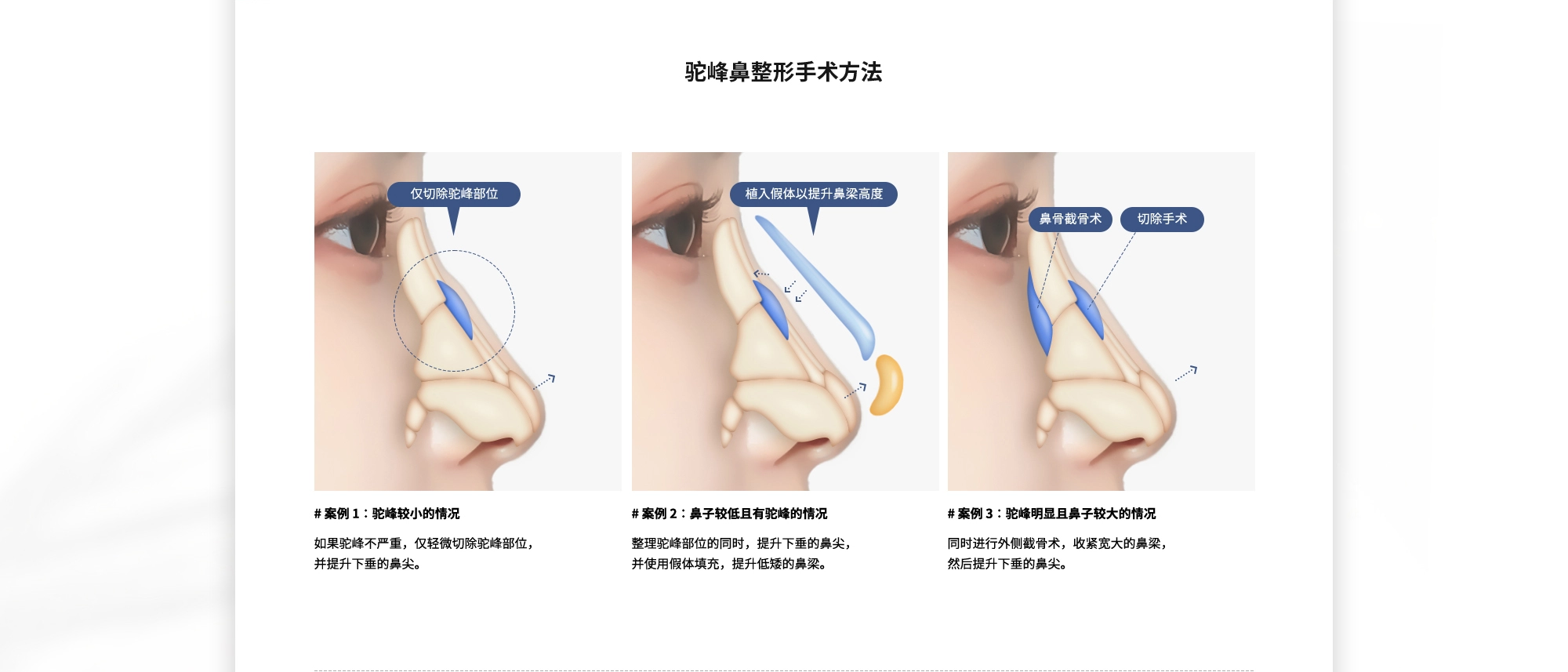 [驼峰鼻整形手术方法] {案例 1：驼峰较小的情况} 如果驼峰不严重，仅轻微切除驼峰部位，并提升下垂的鼻尖  {案例 2：鼻子较低且有驼峰的情况} 整理驼峰部位的同时，提升下垂的鼻尖，并使用假体填充，提升低矮的鼻梁。  {案例 3：驼峰明显且鼻子较大的情况} 同时进行外侧截骨术，收紧宽大的鼻梁，然后提升下垂的鼻尖。