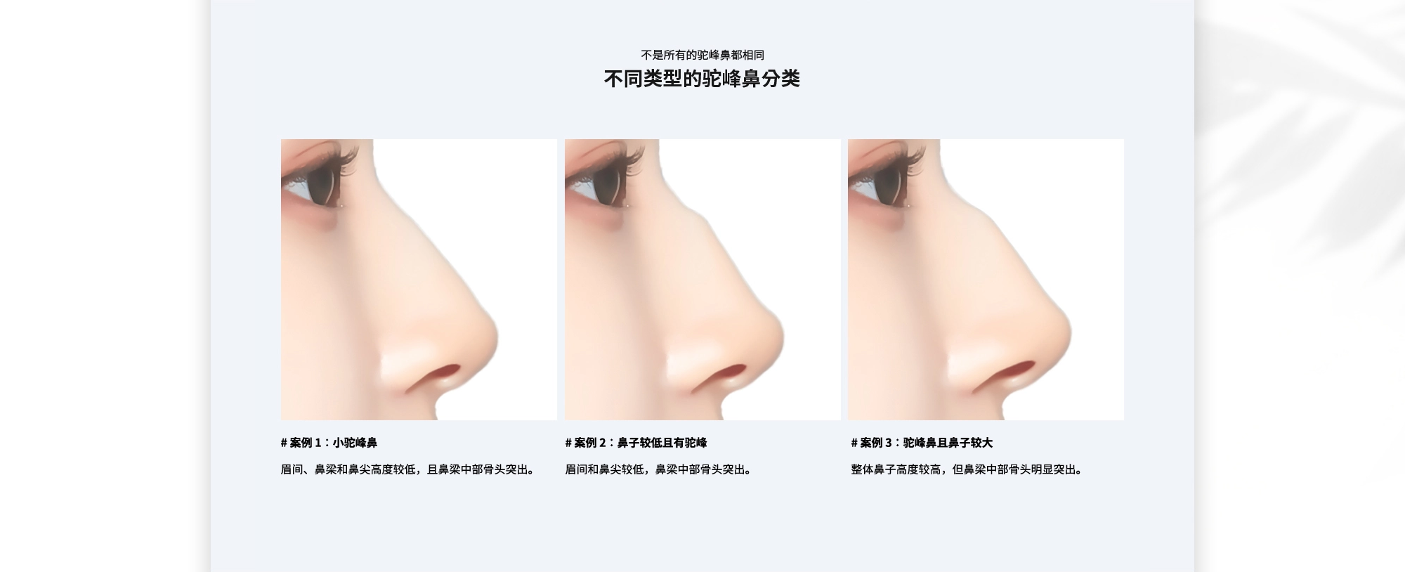 [不是所有的驼峰鼻都相同 不同类型的驼峰鼻分类] {# 案例 1：小驼峰鼻} 眉间、鼻梁和鼻尖高度较低，且鼻梁中部骨头突出。  {# 案例 2：鼻子较低且有驼峰} 眉间和鼻尖较低，鼻梁中部骨头突出。  {# 案例 3：驼峰鼻且鼻子较大} 整体鼻子高度较高，但鼻梁中部骨头明显突出。